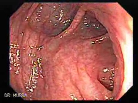 Non Familial Juvenile Polyposis Of The Colon (18 of 37)