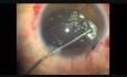 Blunt Ocular Trauma, Pars Plana Anterior Vitrectomy, Phaco, CTR and IOL Implant