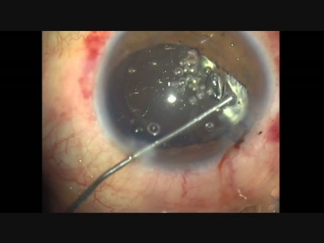 Blunt Ocular Trauma, Pars Plana Anterior Vitrectomy, Phaco, CTR and IOL Implant
