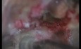 Petroclival Meningioma - Right Transpetrosal Approach