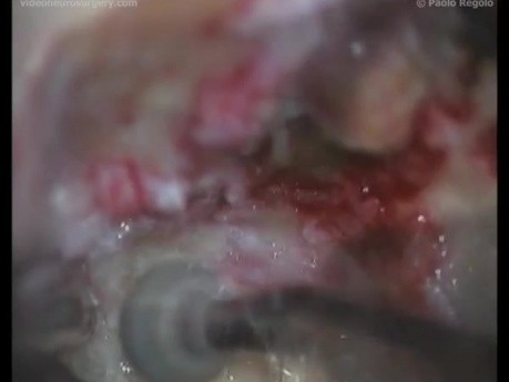 Petroclival Meningioma - Right Transpetrosal Approach