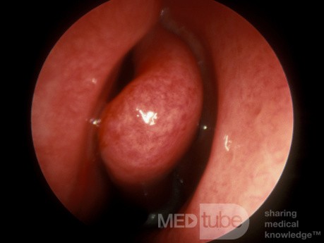Acute Viral Rhinitis [URI]
