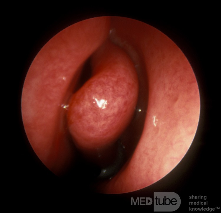 Acute Viral Rhinitis [URI]