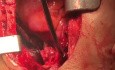 Repair of LT Pulmonary Artery with Patch in Order to Impede Pulmonary Artery Stenosis