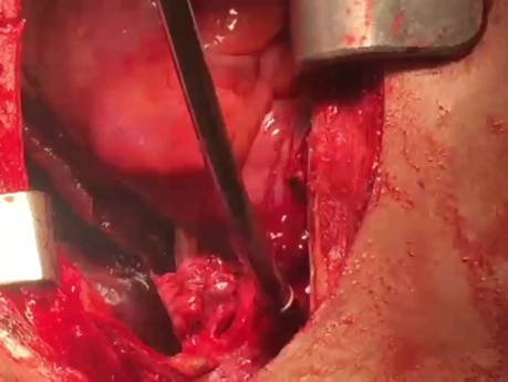Repair of LT Pulmonary Artery with Patch in Order to Impede Pulmonary Artery Stenosis