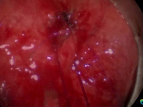 Recto Vesical Fistula After Prostatectomy - Transanal Surgery