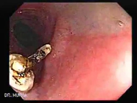 Colonoscopic Polypectomy (16 of 29)