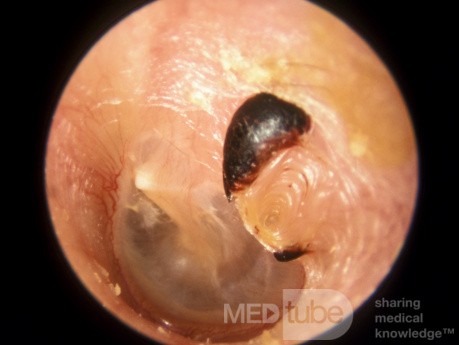 Traumatic Perforation of the Left Tympanic Membrane Healed After one Month