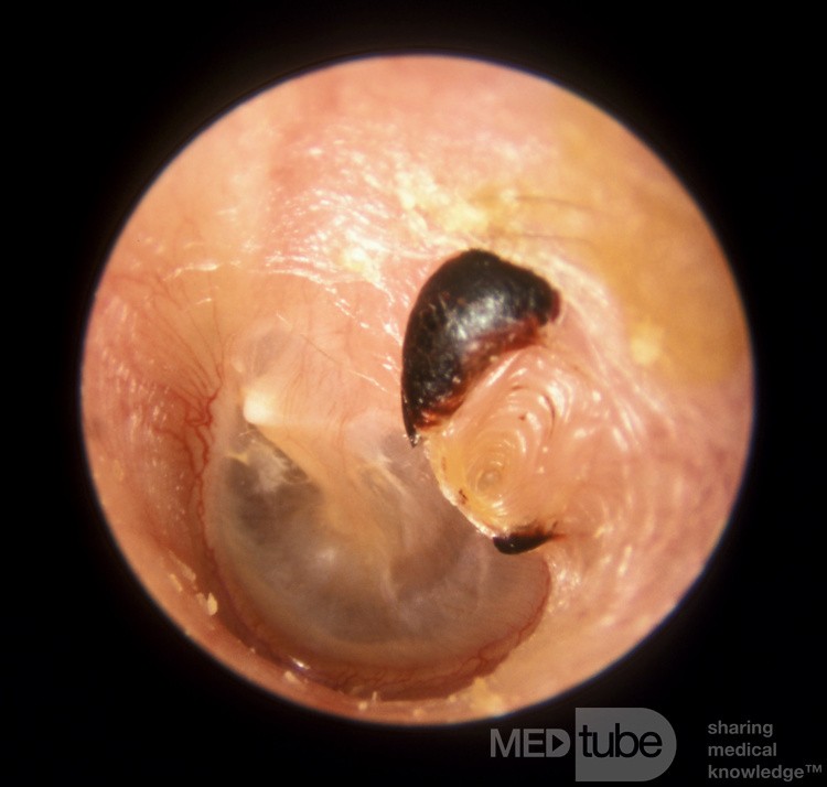 Traumatic Perforation of the Left Tympanic Membrane Healed After one Month