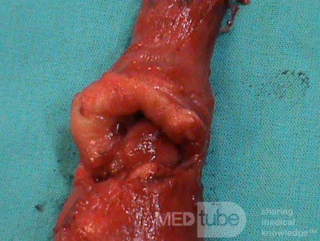 Barrett Adenocarcinoma - Endoscopic Image (17 of 20)