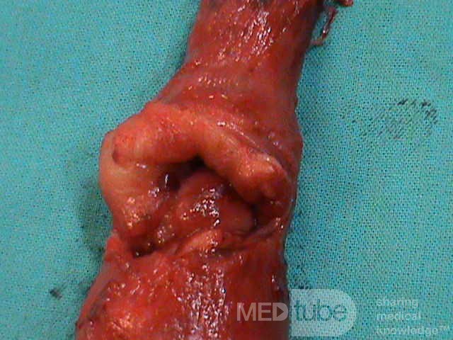 Barrett Adenocarcinoma - Endoscopic Image (17 of 20)