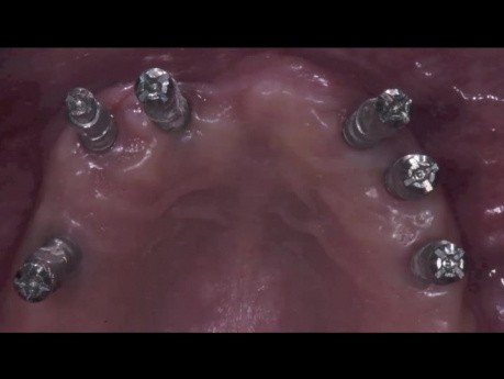 Bimaxillary edentulism - Computer Guided Dental Implants