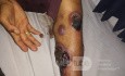 Identifying Lesions