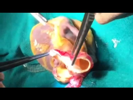 Ortho Topic Heart Transplantation From A to Z 