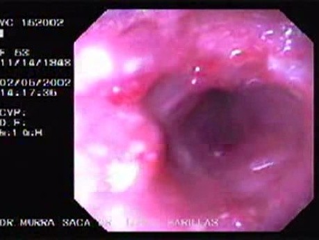 Severe Case Of Ulcerative Colitis (2 of 6)