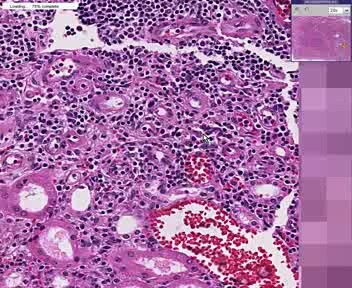 Kidney - Acute Transplant Rejection