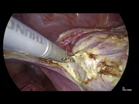 Total Laparoscopic Hysterectomy - Does Size Matter?