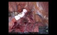 Robotic Right S1 Segmentectomy (Unedited)