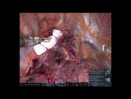 Robotic Right S1 Segmentectomy (Unedited)