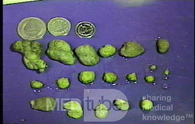 Juvenile Non Familial Polyposis of the Colon (13 of 37)
