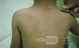 Herald Patch - Pityriasis Rosea