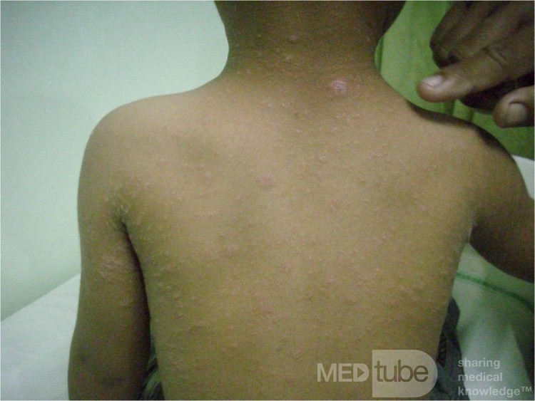 Herald Patch - Pityriasis Rosea