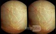 Lymphatics of the Conjunctiva - 3D