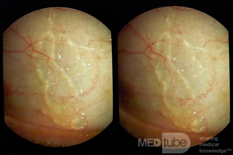 Lymphatics of the Conjunctiva - 3D