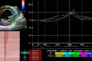 Dyskinetic Anterior Left Ventricular Wall