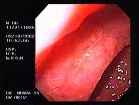 MALT Lymphoma - Assessment of the Gastric Mucosa