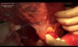 Isolated Pancreatic Head Resection and Duodenectomy for GIST