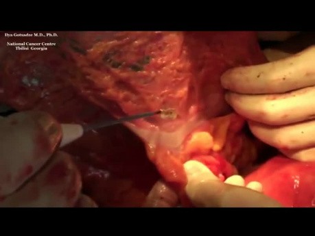 Isolated Pancreatic Head Resection and Duodenectomy for GIST