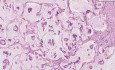 Colloid carcinoma - Histopathology - Breast