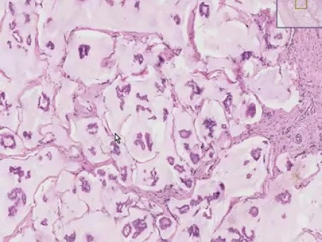 Colloid carcinoma - Histopathology - Breast