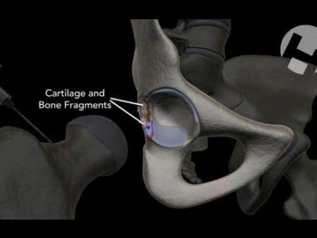 Open Reduction Internal Fixation