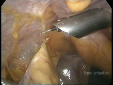 Laparoscopic Cholecystectomy in Patient with Previous Open Hepatic Surgery