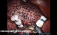 Pulmonary S8+9 Segmentectomy of the Right Lower Lobe