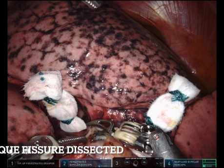 Pulmonary S8+9 Segmentectomy of the Right Lower Lobe