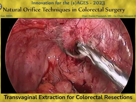 Transvaginal Extraction for Colorectal Resections