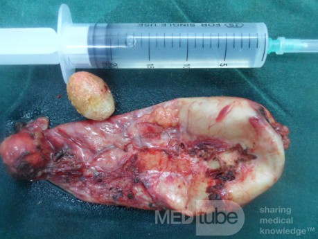 Acute cholecystitis removed by Lap chole