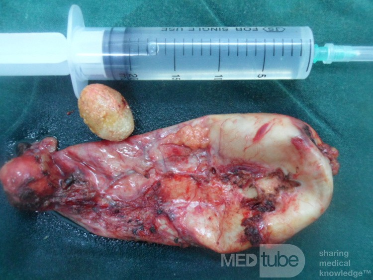 Acute cholecystitis removed by Lap chole