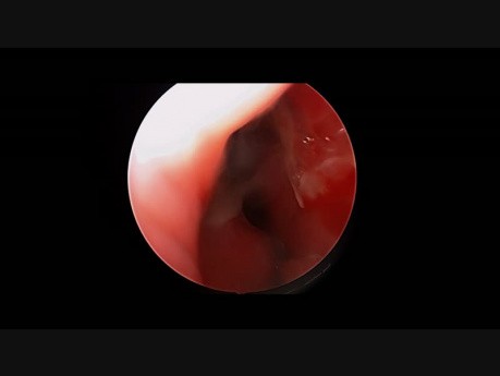 Repair of Perforation