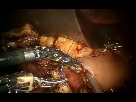 How Do We Form Pancreatogastroanastomosis During Robot-Assisted and Laparoscopic Whipple Procedure