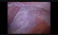 Lymphatic cyst
