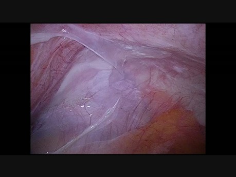 Lymphatic cyst