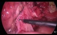 Laparoscopic Emergency Surgery for Acute Diverticulitis - Hartmann's