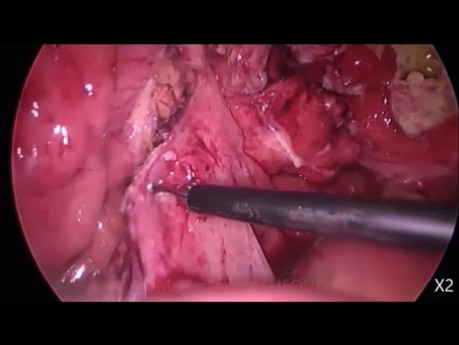 Laparoscopic Emergency Surgery for Acute Diverticulitis - Hartmann's