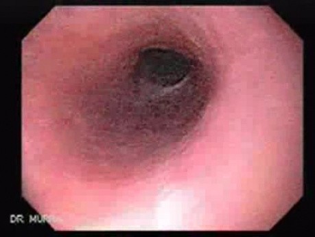 Esophageal Candidiasis Infected with Bacteria - Hiatus Hernia and Signs of Reflux Esophagitis