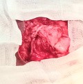 Meningocele in an 18-year-old patient