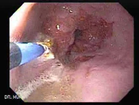 Endoscopic Ablation Of Barrett's Esophagus - 1/6